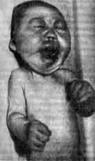 Голопрозэнцефалия (holoprosencephaly)