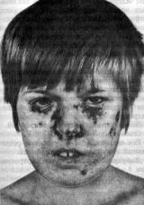 Ксеродерма пигментная (xeroderma pigmentosum)