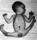 Ларсена синдром (Larsen syndrome)