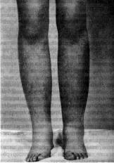 Лимфедема, тип I (lymphedema, type&nbsp;I)