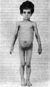 Липодистрофия тотальная врожденная (congenital total lipodystrophy)