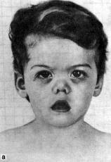 Маршалла синдром (Marshall syndrome)