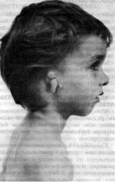 Микротия-атрезия (microtia-atresia)