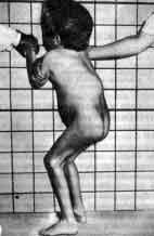 Мукополисахаридоз, тип I (mucopolysaccharidosis, type&nbsp;I)