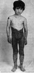 Нейрокожный меланоз (neurocutaneous melanosis)