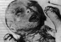 Ноя-Лаксовой синдром (Neu-Laxova syndrome)