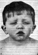 Нунан синдром (Noonan syndrome)