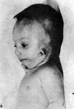 Окуло-аурикуло-вертебральная дисплазия (oculo-auriculo-vertebrae dysplasia)