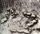 Keratosis follikulares
