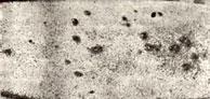 Keratosis follicularis serpiginosa lutz