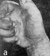 Acropathia ulceromutilans pseudosyringomyelitica (а)
