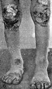 Acrodermatstis enteropathica (б)