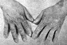 Erythema elevatum diutinum