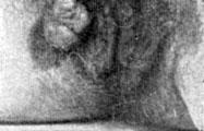 Chorionepithelioma metastaticum vaginae
