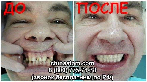 Сколько стоят услуги стоматолога в Китае? Цены на стоматологию в Хэйхэ
